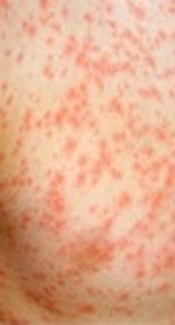 A Survey on Measles and Rubella Supplementary Immunization Activities (SIAs) in Iran
